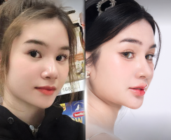 Nâng Mũi Đẹp Tự Nhiên, An Toàn Chuẩn Y Khoa tại Long Khánh – Thẩm Mỹ Viện Bác Sĩ Kim Hà